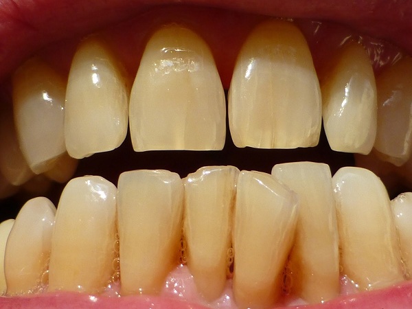 Tại sao răng bị vàng và giải pháp khắc phục hiệu quả