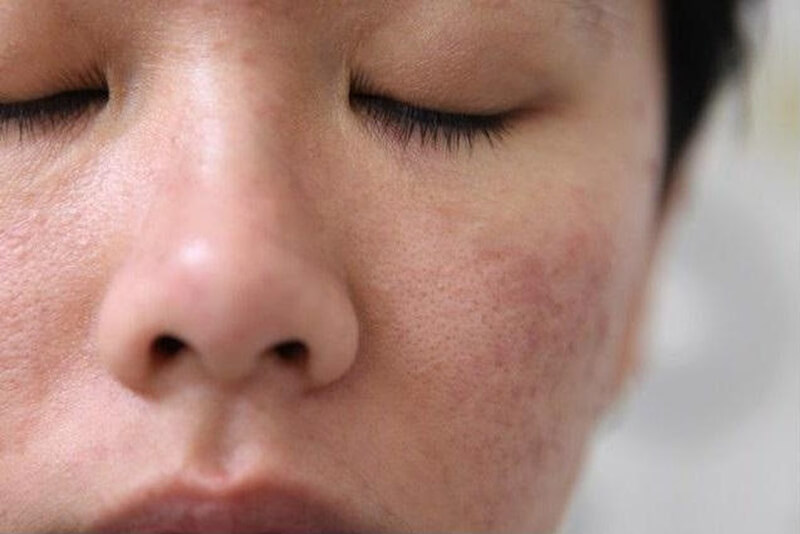 Lỗ chân lông nở to gây nhiều ảnh hưởng đến làn da